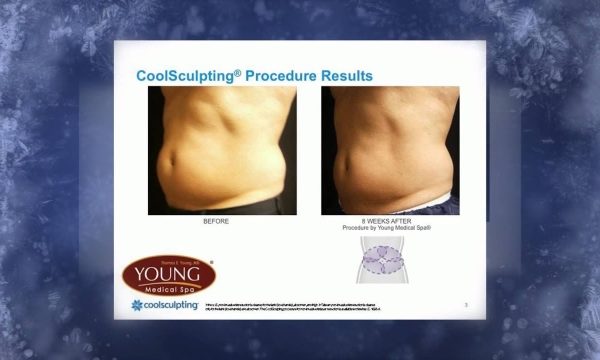 Transform Your Body with CoolSculpting: The Science behind Fat Freezing