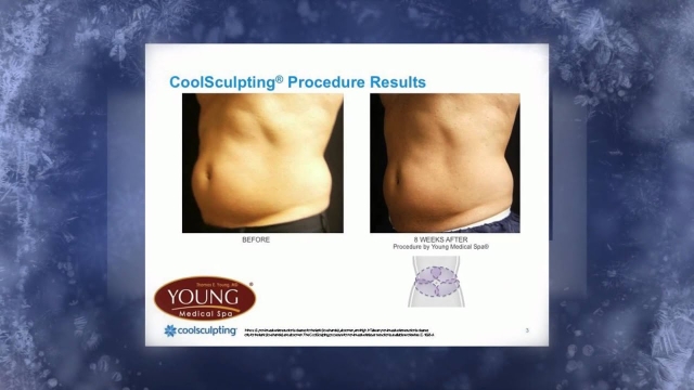 Transform Your Body with CoolSculpting: The Science behind Fat Freezing