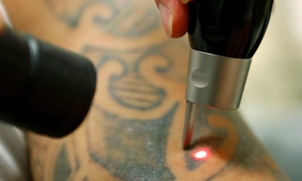 Understanding Tattoo Removal Cost Factors