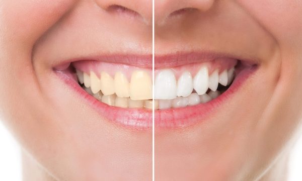 Blindingly Bright: Unveiling the Secrets of Teeth Whitening
