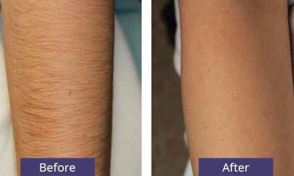 Say Goodbye to Unwanted Hair: The Ultimate Guide to Laser Hair Removal