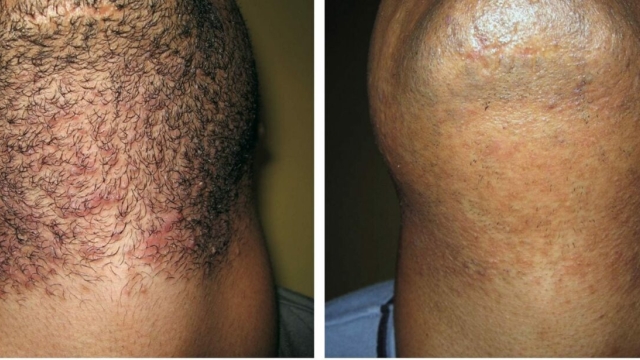 Laser Hair Removal: A Smooth Solution